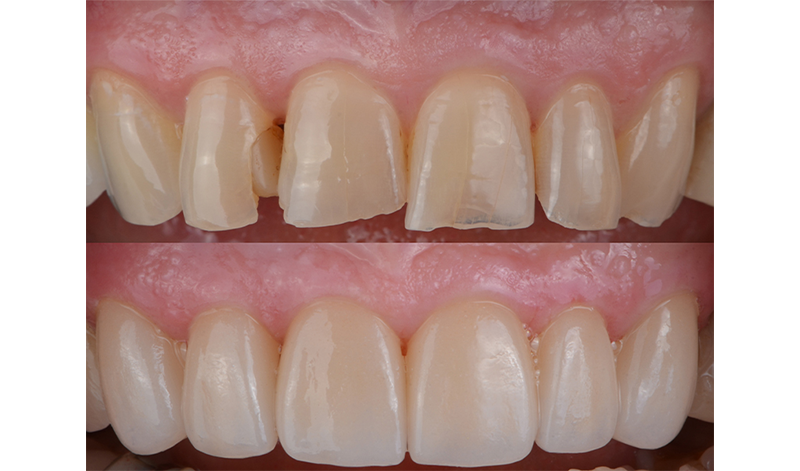 Zähne mit Keramik Veneers im Vorher-Nachher-Vergleich