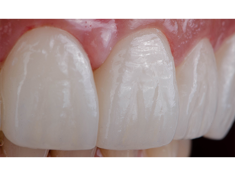 Natürliche Oberflächentextur auf Zähnen