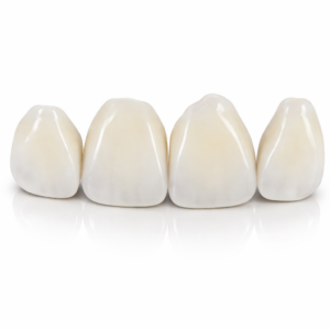 Festsitzender Zahnersatz - Veneers